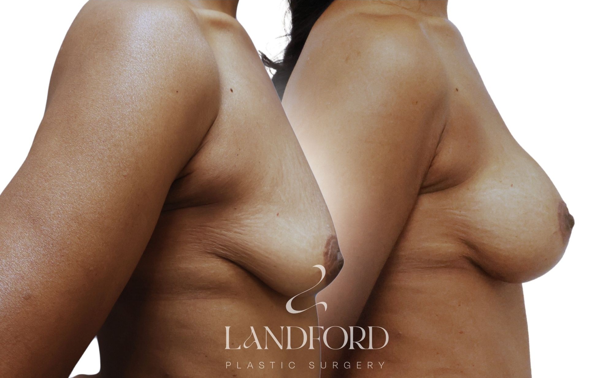 Breast Augmentation