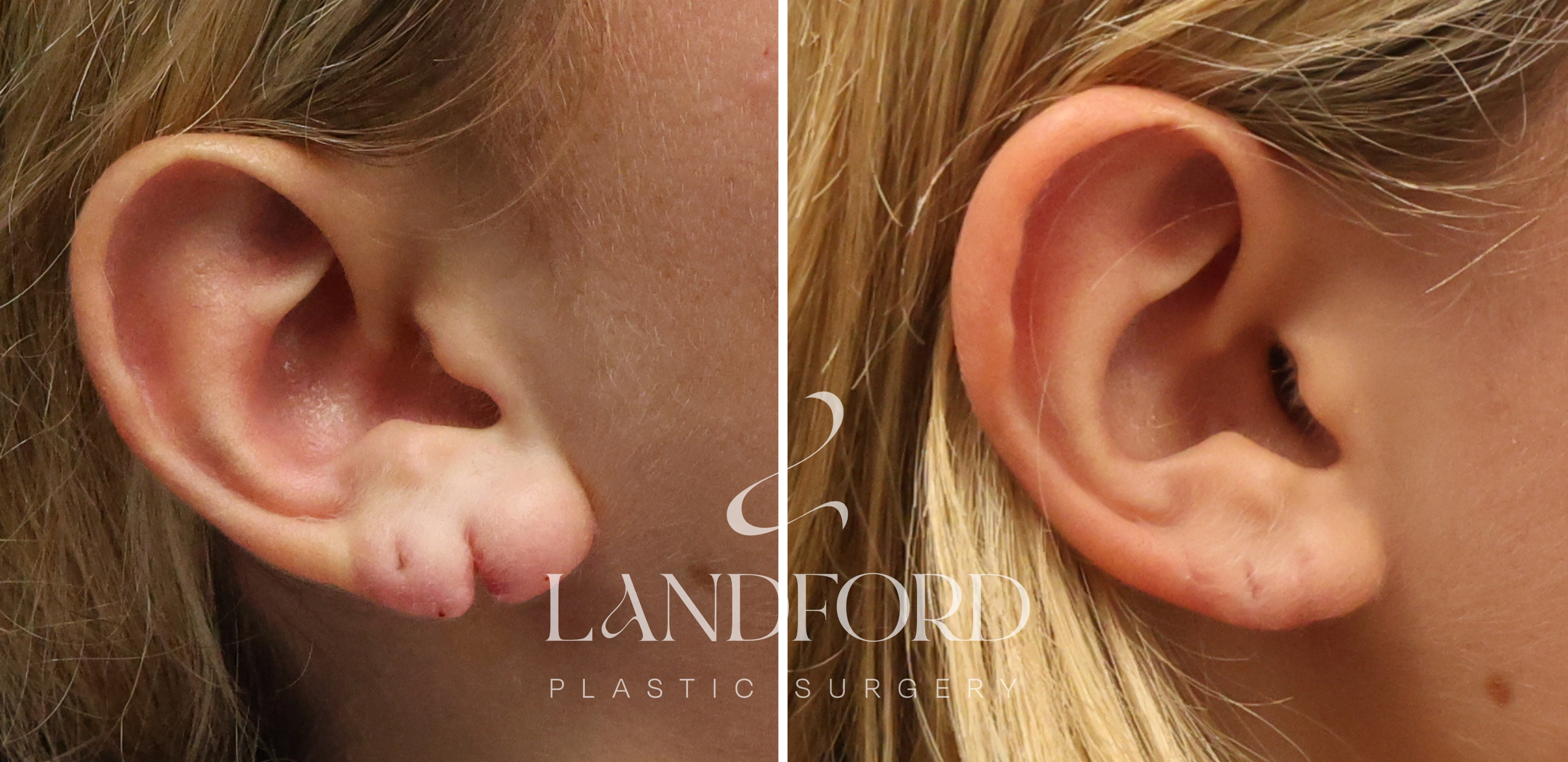 Earlobe Repair