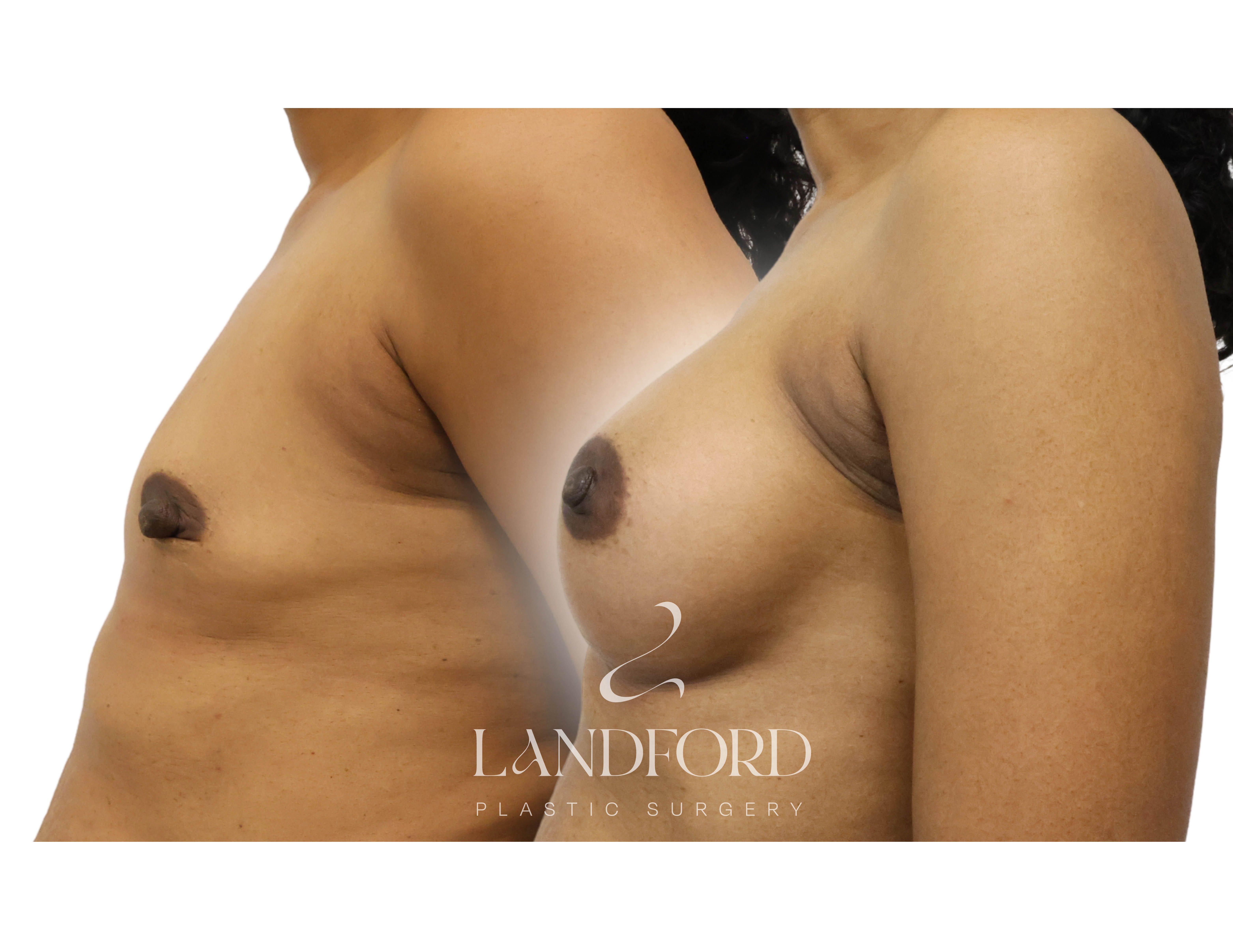 Breast Augmentation