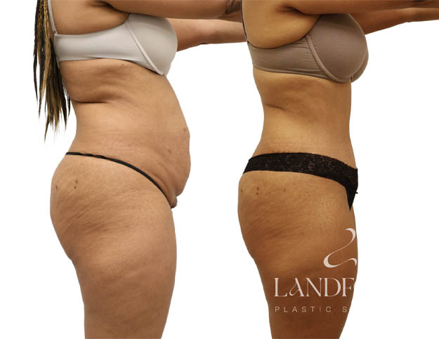 Abdominoplasty
