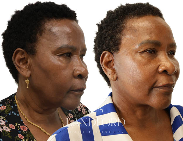 Facelift