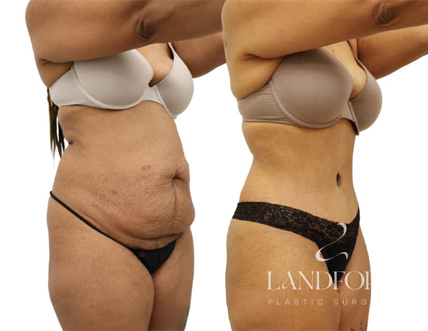 Abdominoplasty