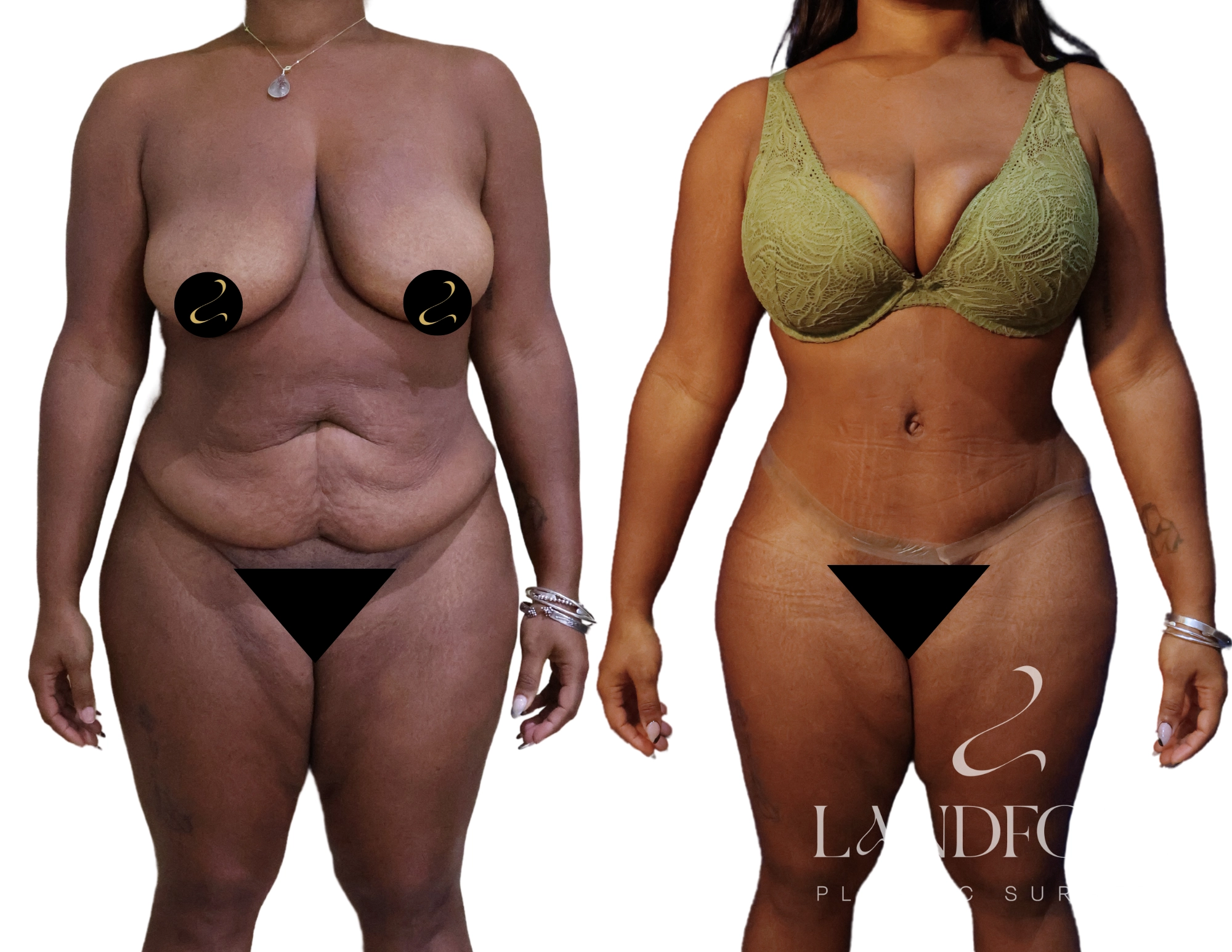 Abdominoplasty
