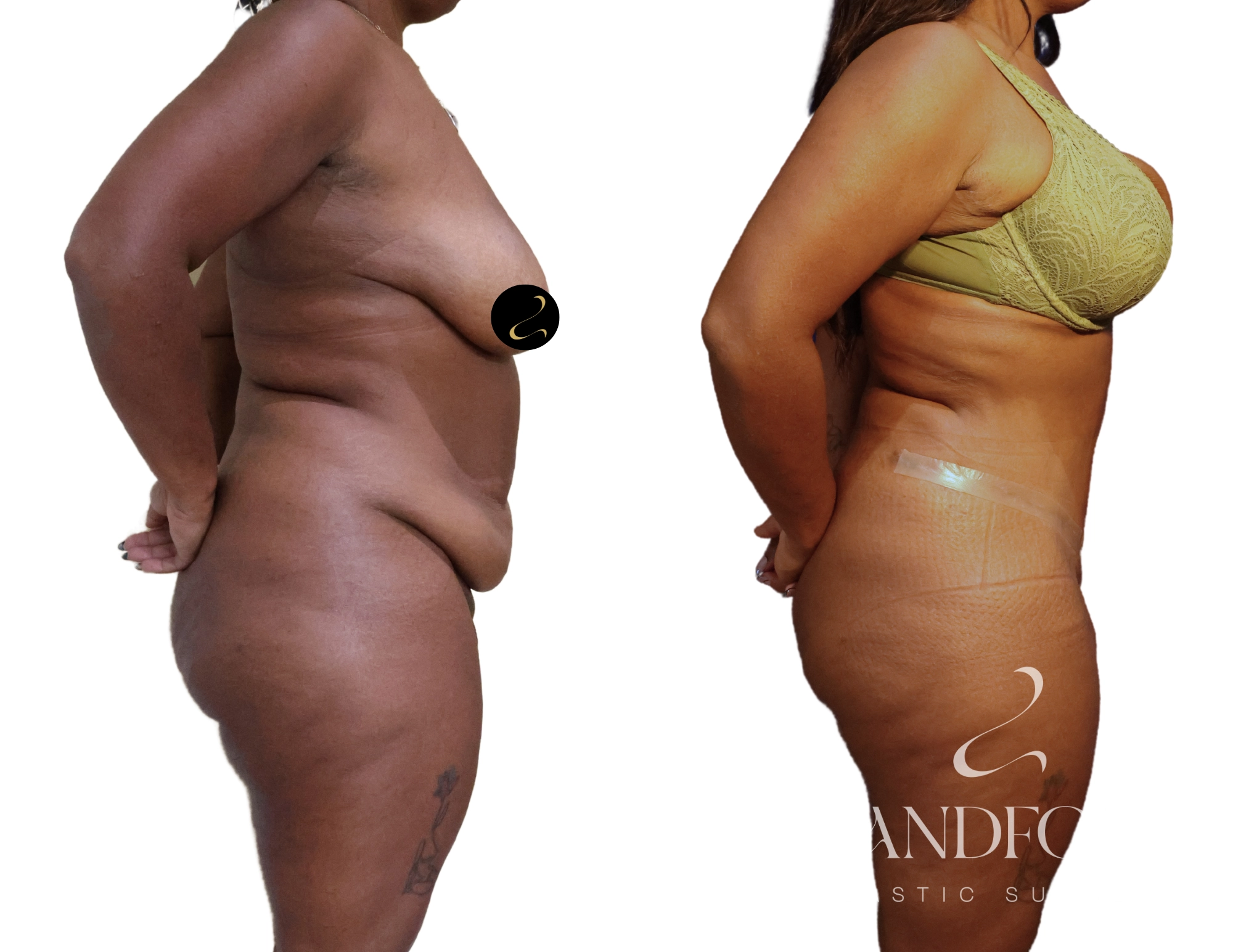 Abdominoplasty