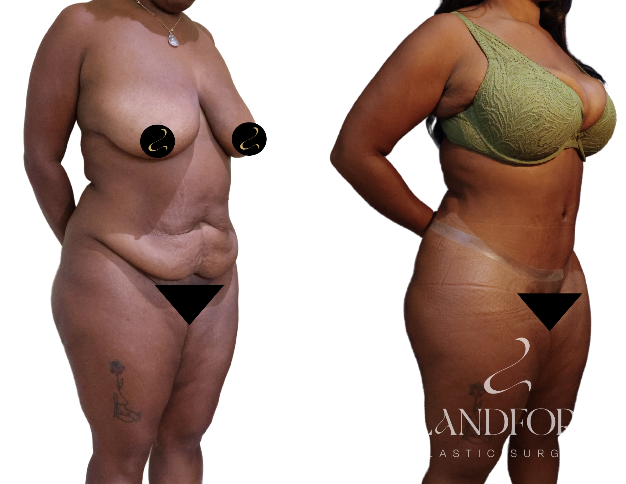 Abdominoplasty