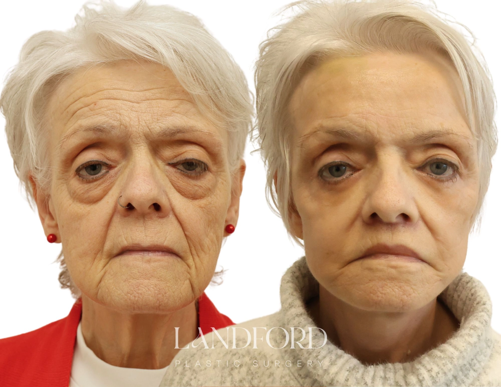 Facelift & Neck Lift