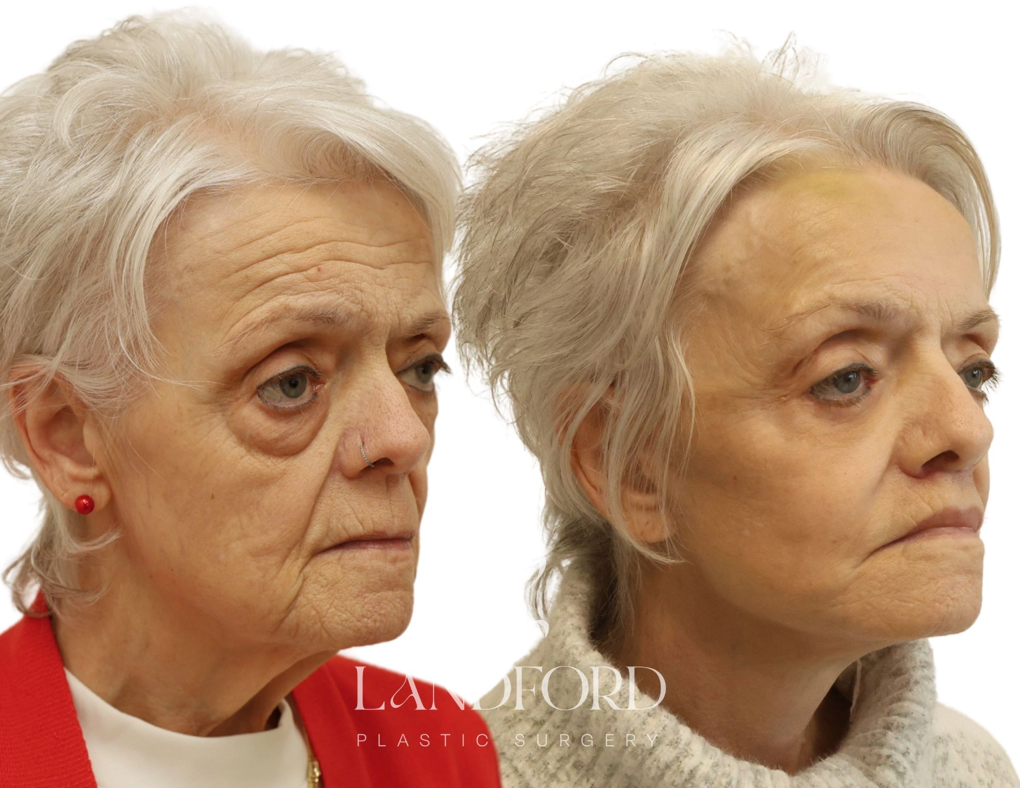 Facelift & Neck Lift