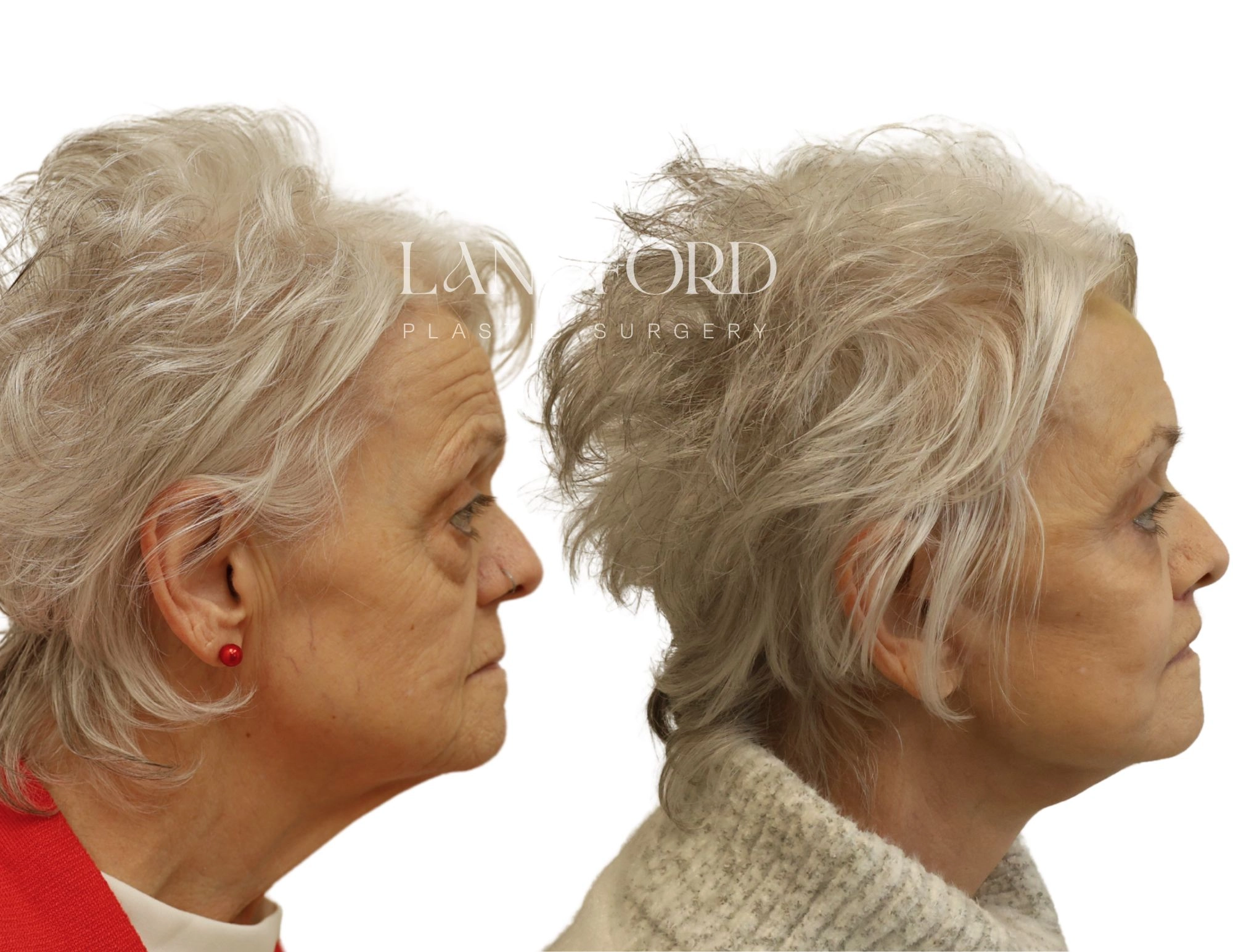 Facelift & Neck Lift