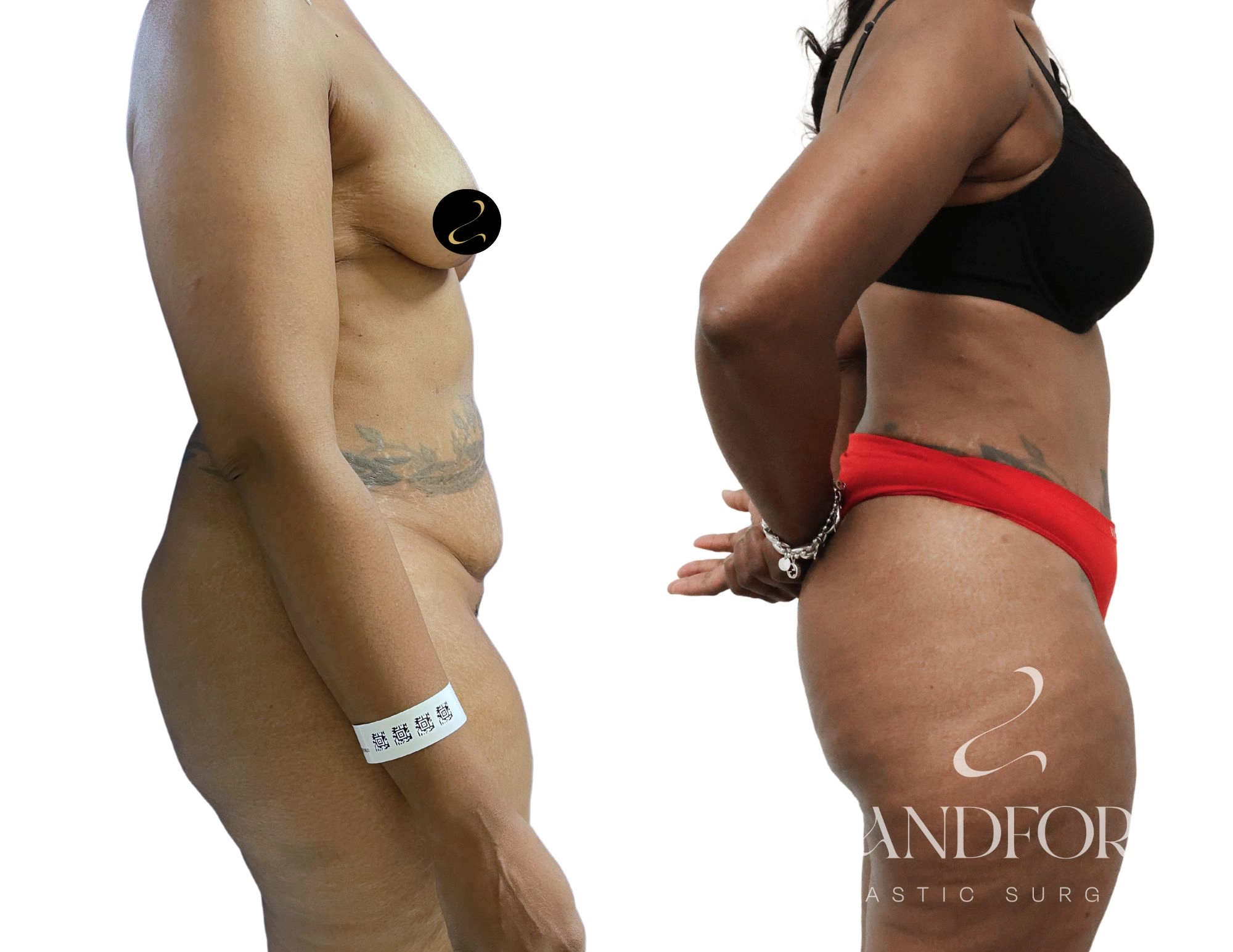 Abdominoplasty