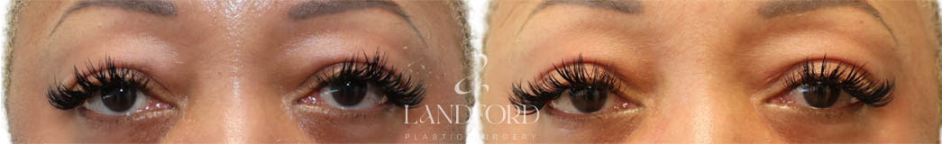 Blepharoplasty