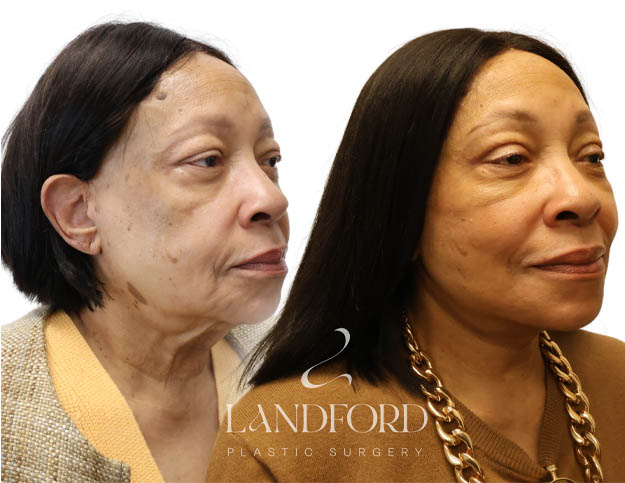 Facelift