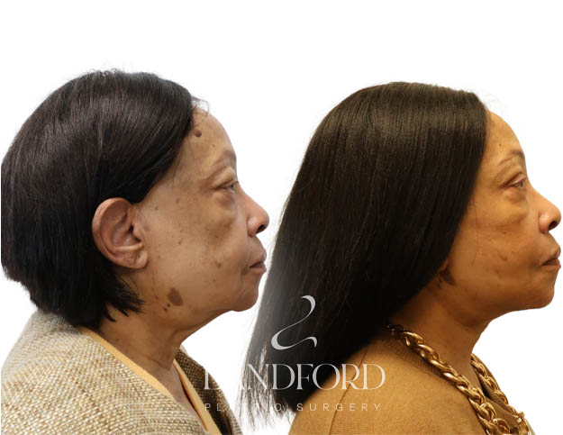 Facelift