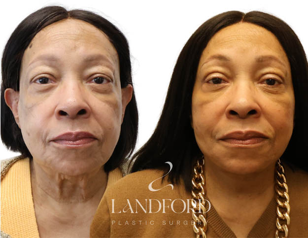 Facelift