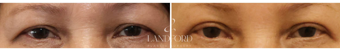 Blepharoplasty