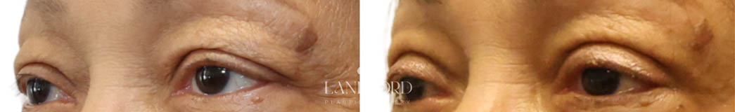 Blepharoplasty