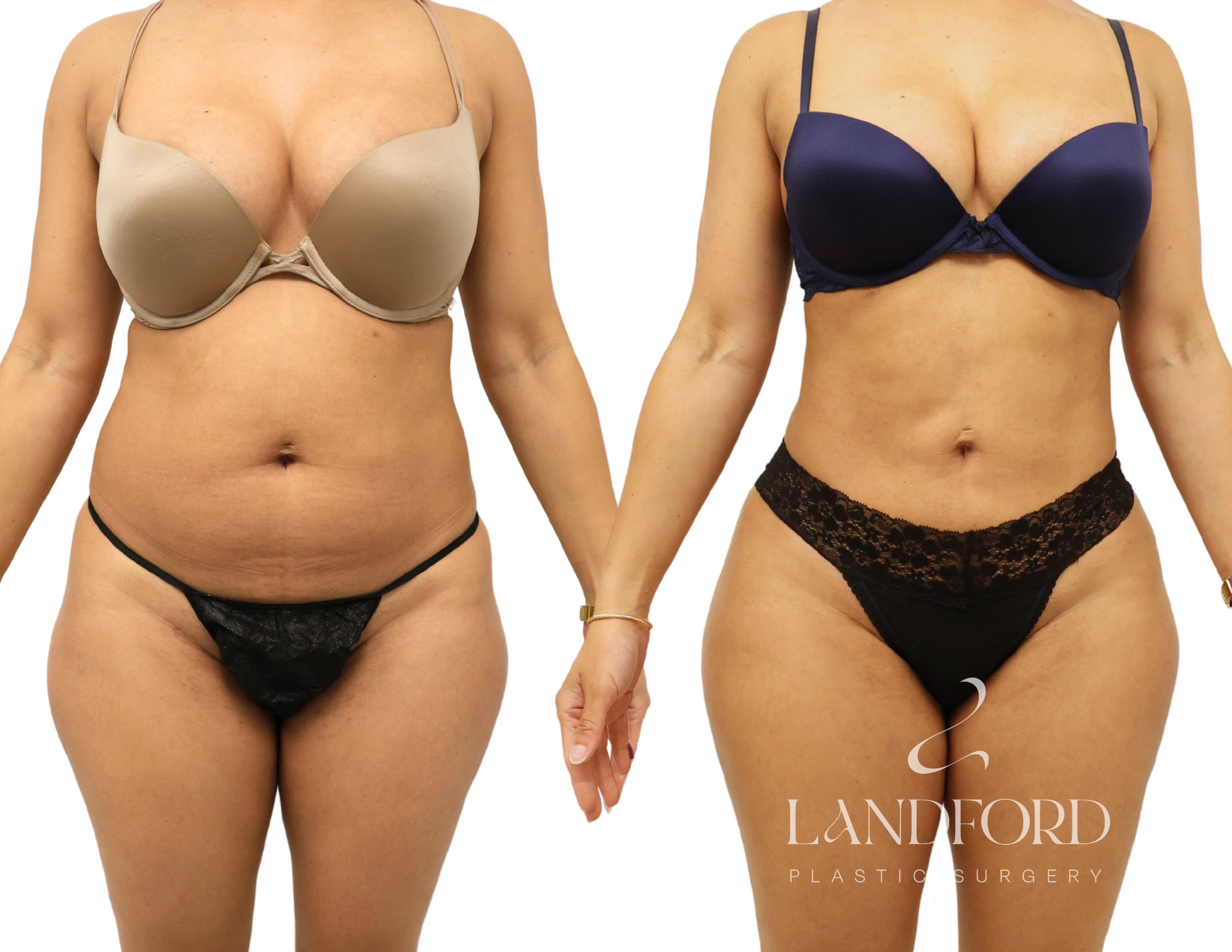 High Definition Liposuction