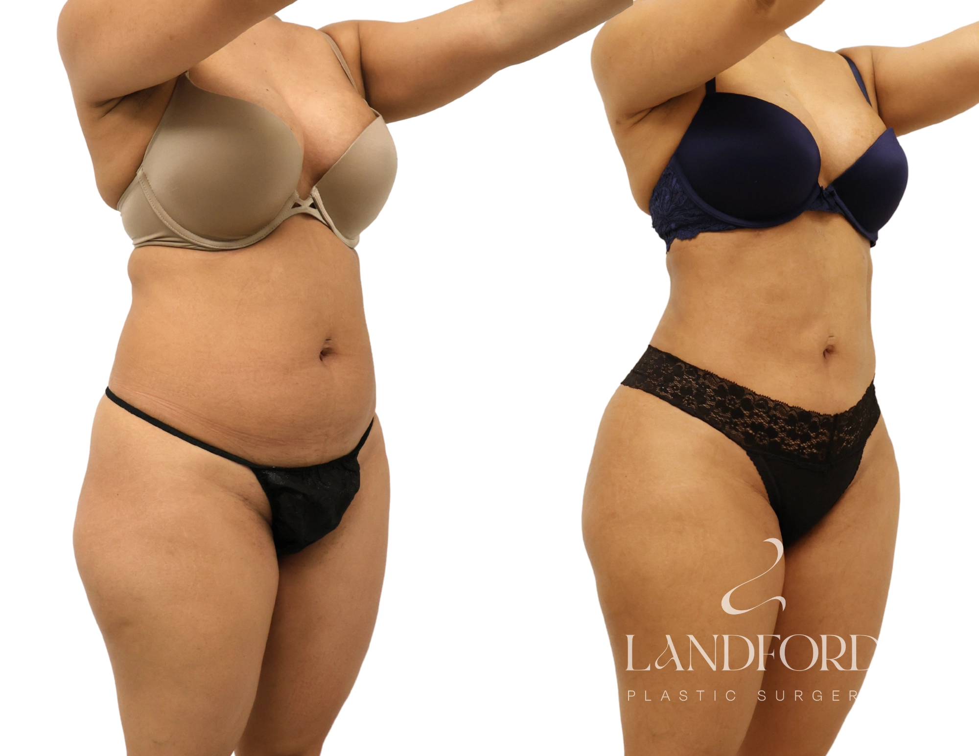 High Definition Liposuction