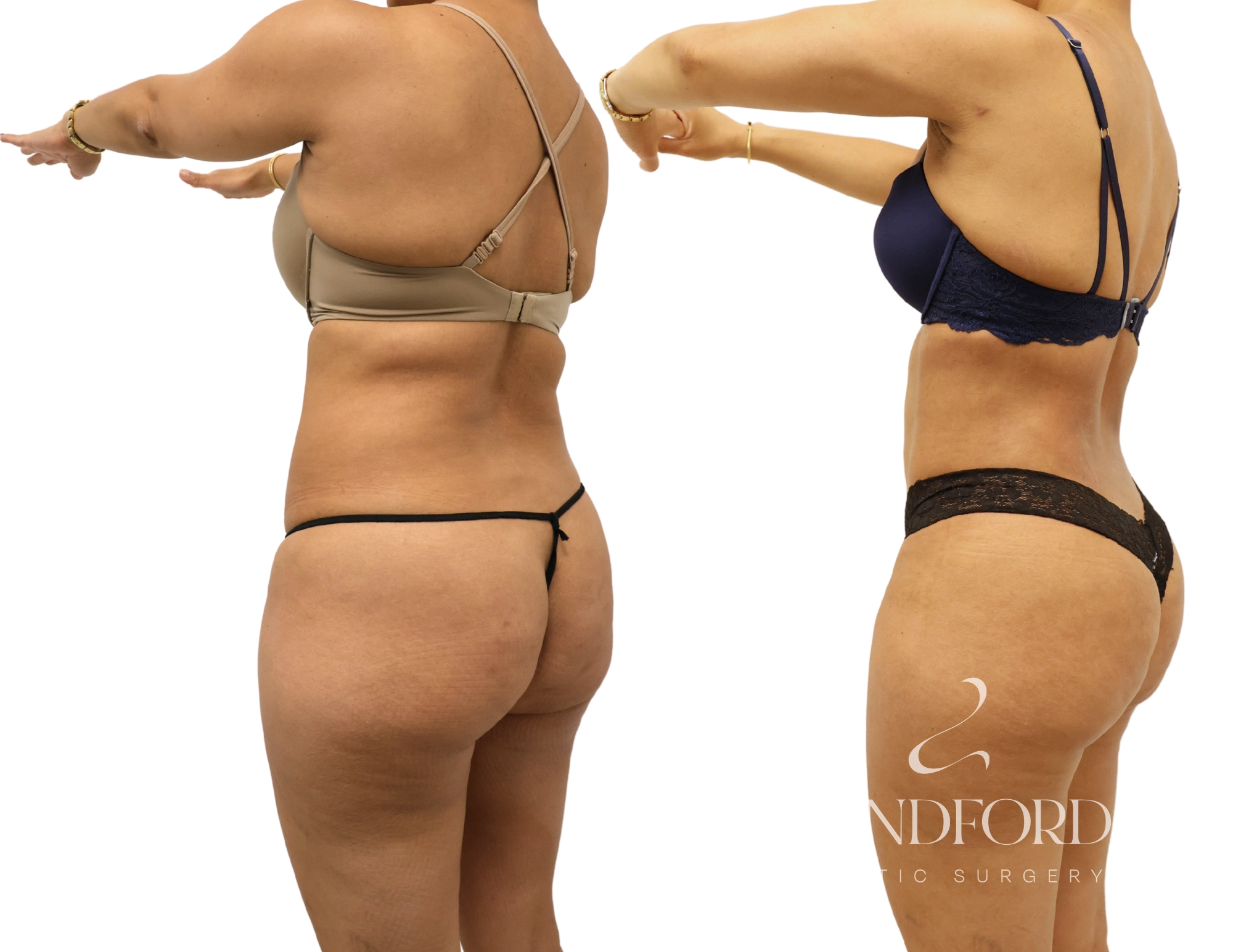 High Definition Liposuction