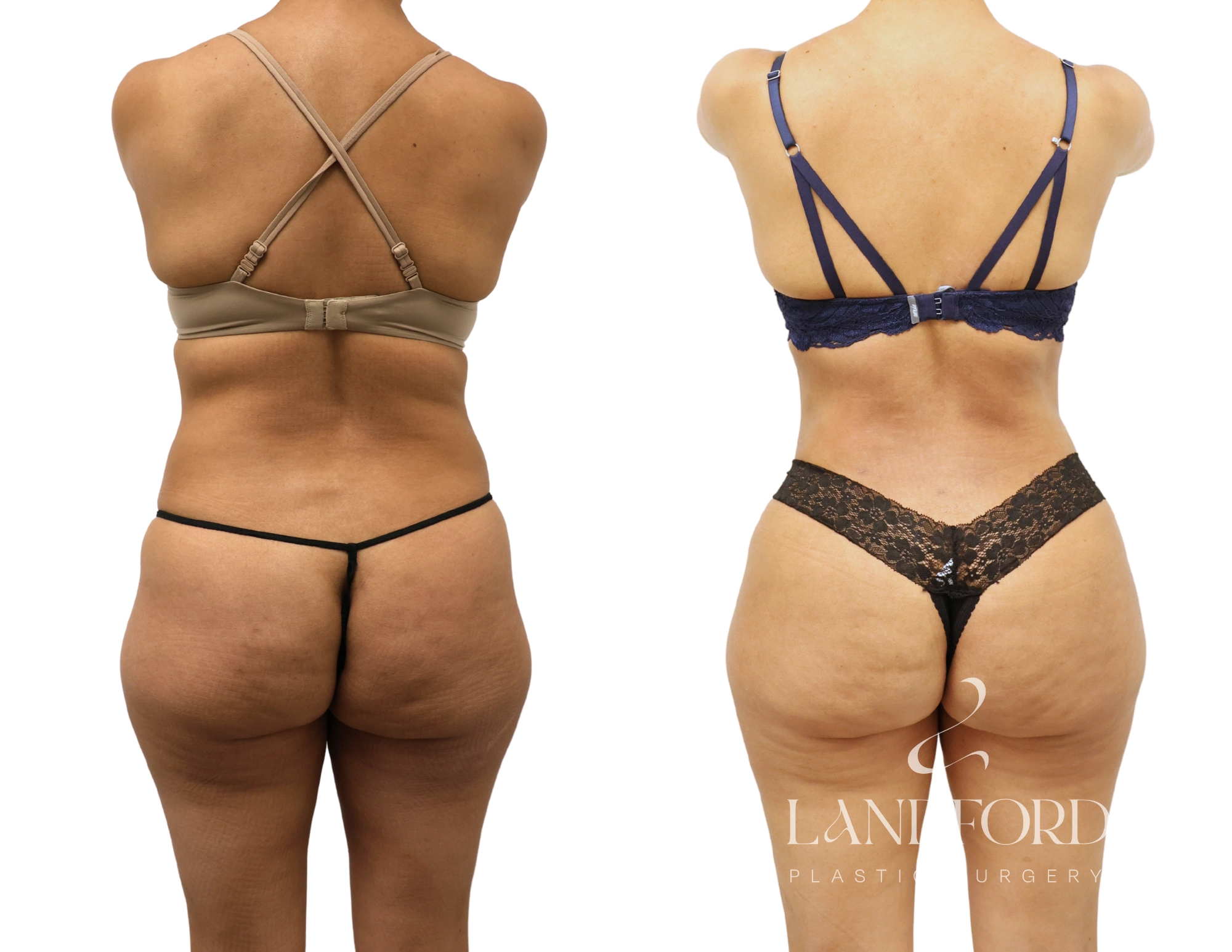 High Definition Liposuction