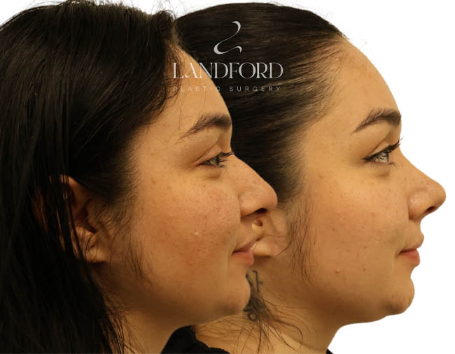 Rhinoplasty