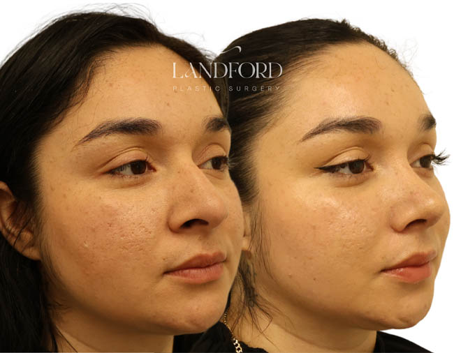 Rhinoplasty