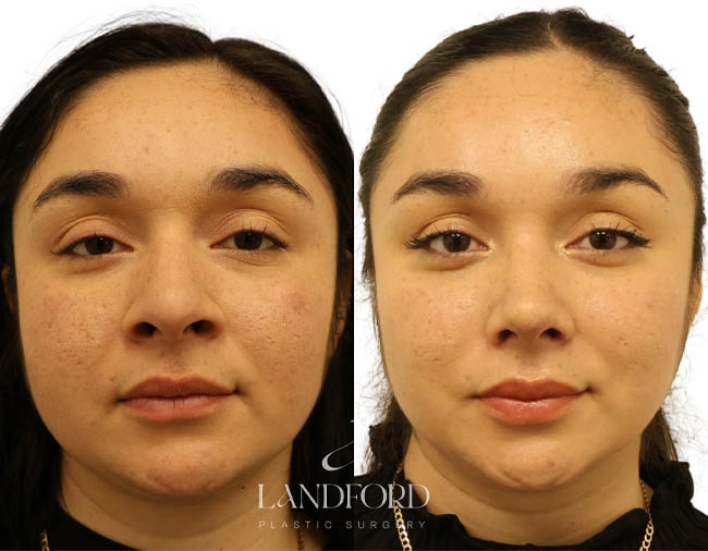 Rhinoplasty