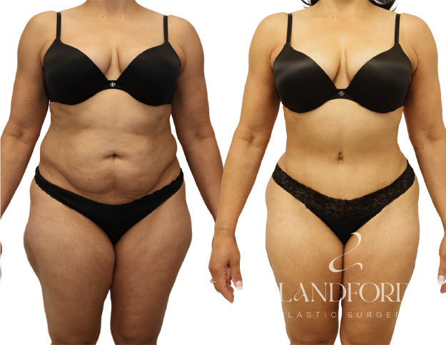 Abdominoplasty