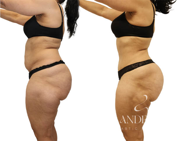 Abdominoplasty
