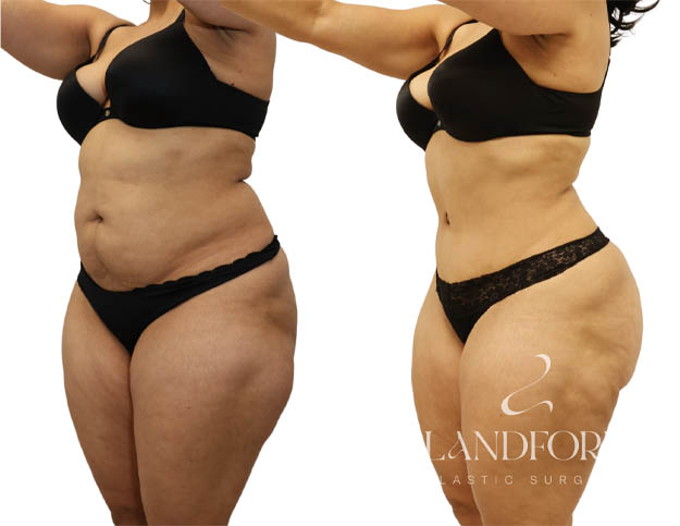 Abdominoplasty