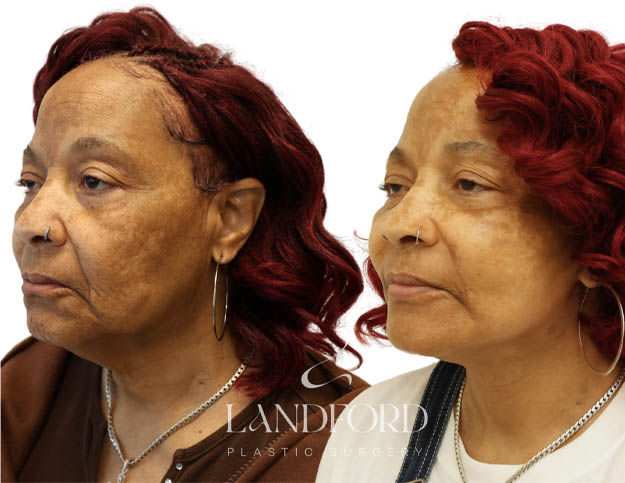 Facelift