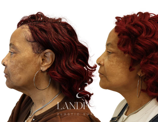 Facelift