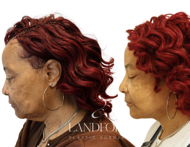 Facelift