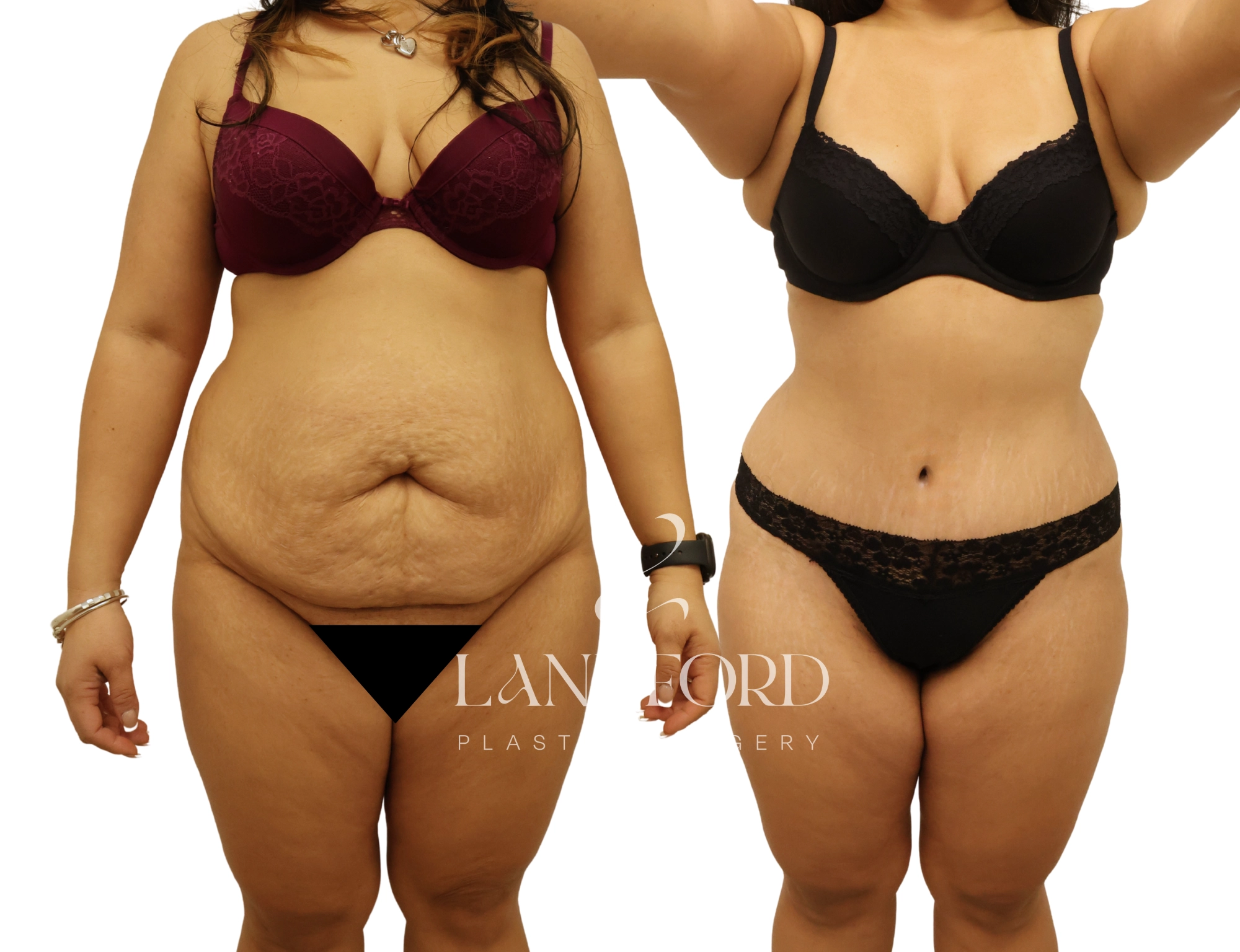Abdominoplasty
