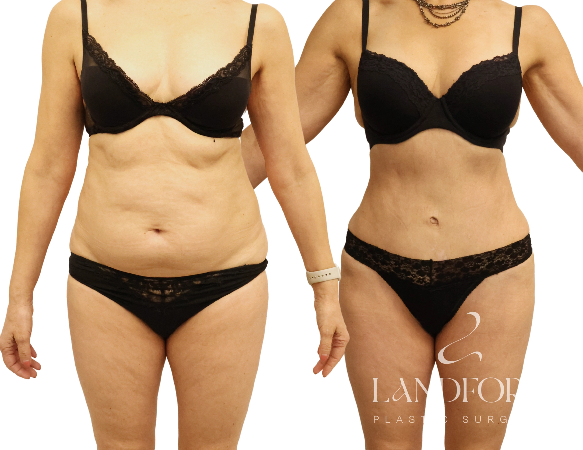 Abdominoplasty
