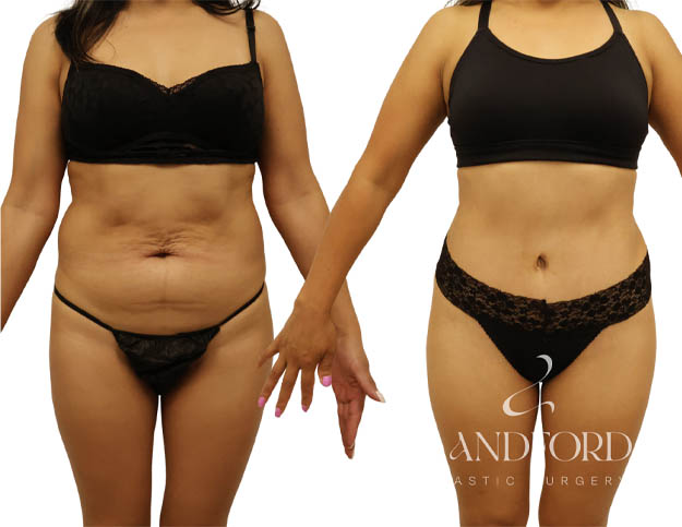Abdominoplasty