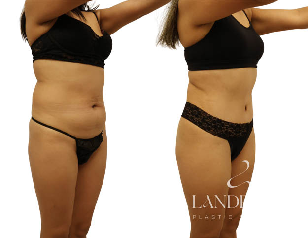 Abdominoplasty