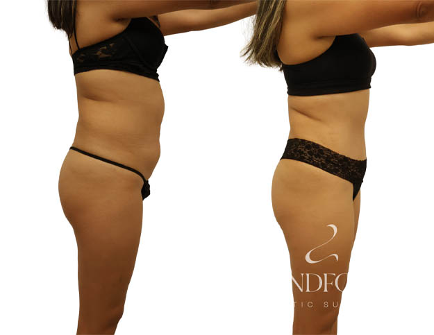 Abdominoplasty
