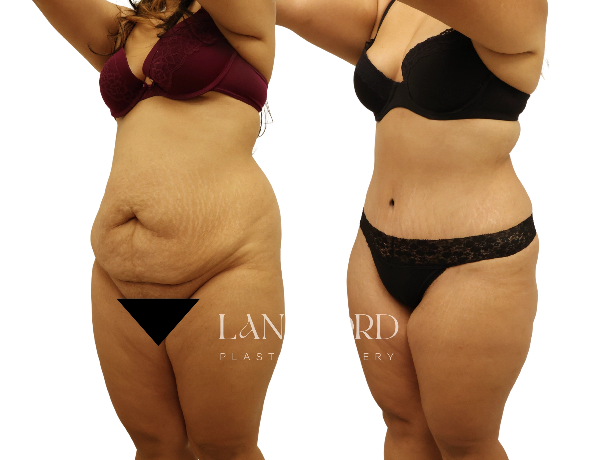 Abdominoplasty