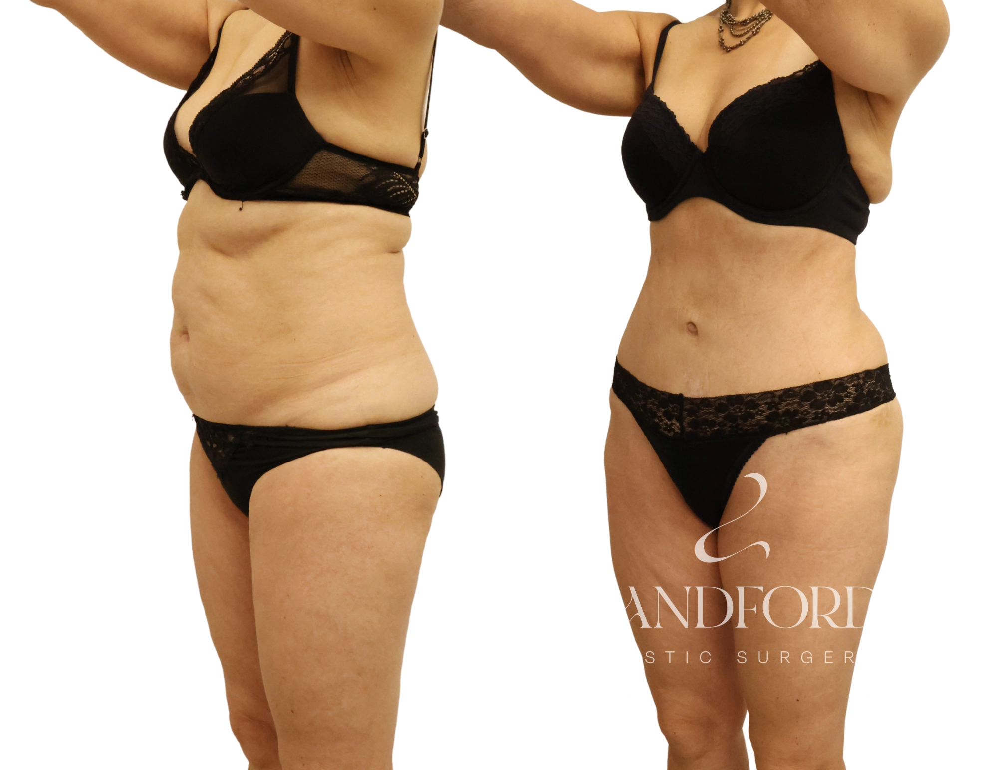 Abdominoplasty