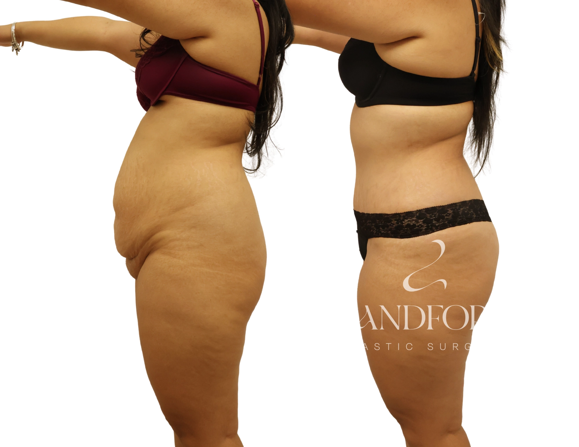 Abdominoplasty