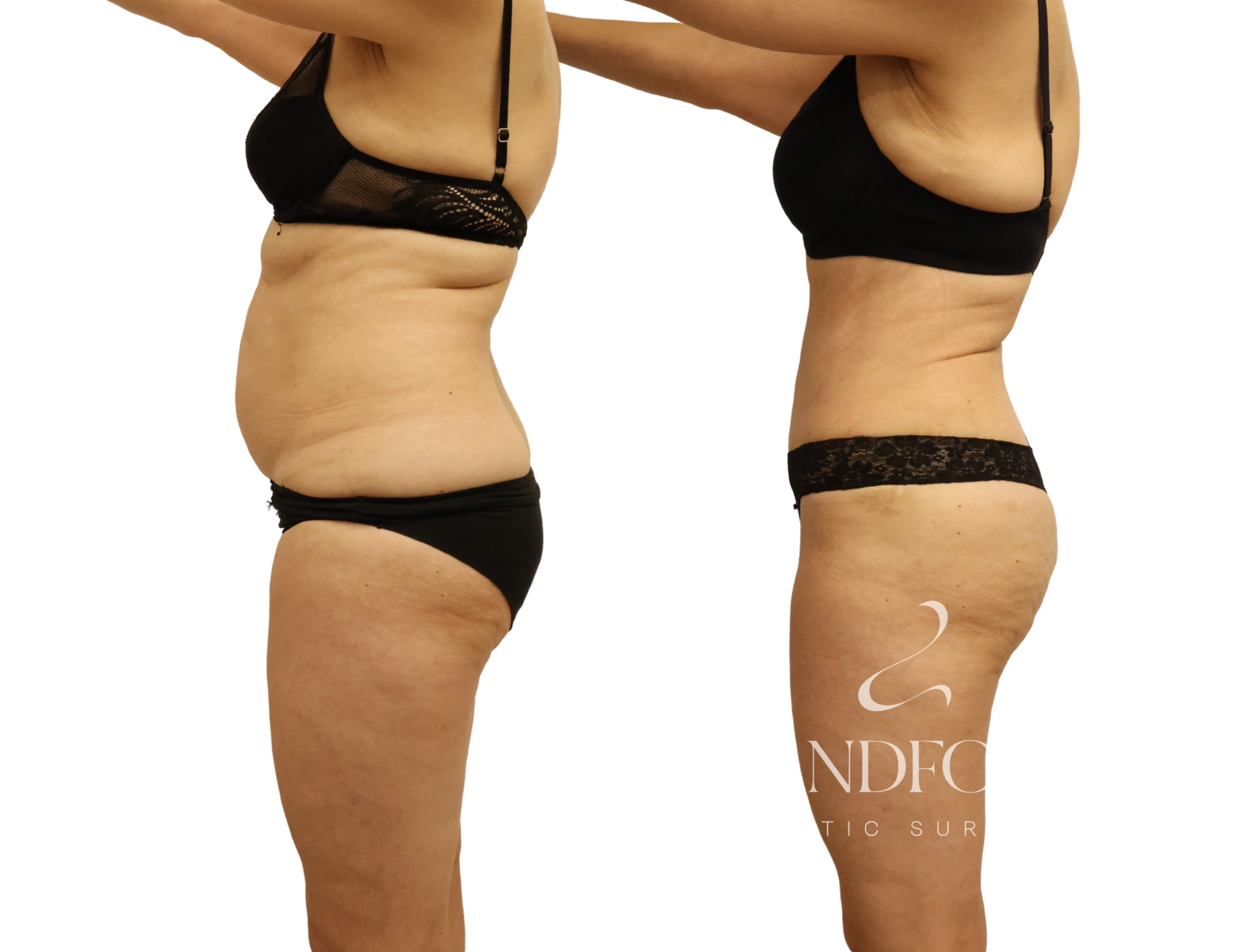 Abdominoplasty