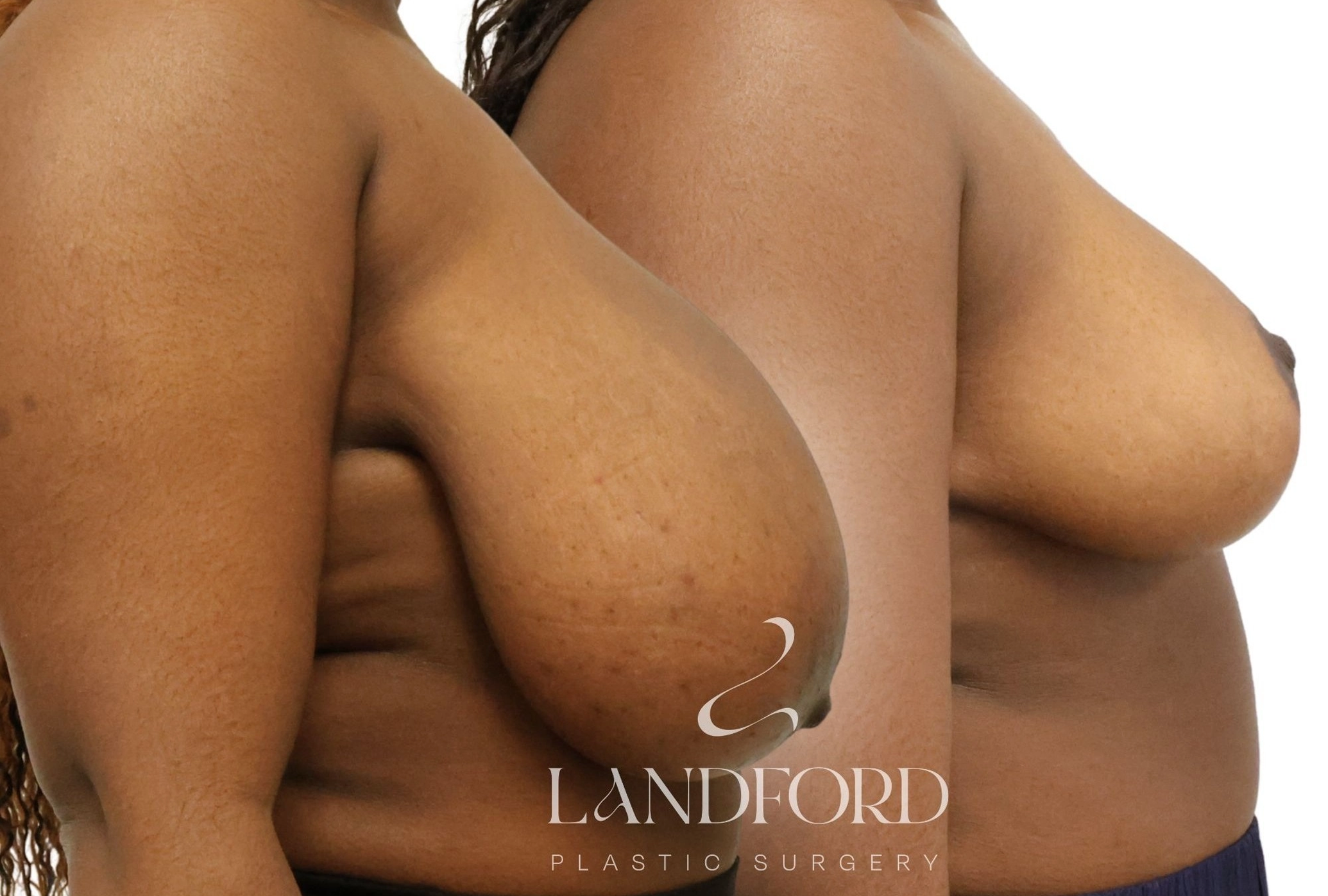 Breast Reduction