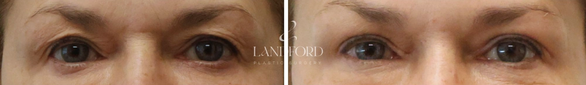 Blepharoplasty