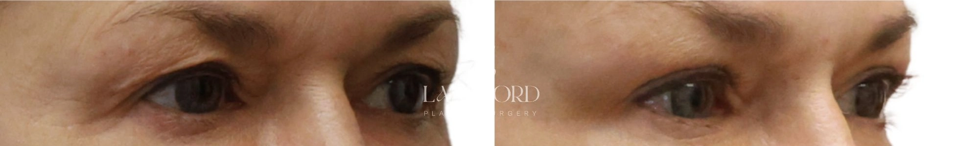 Blepharoplasty