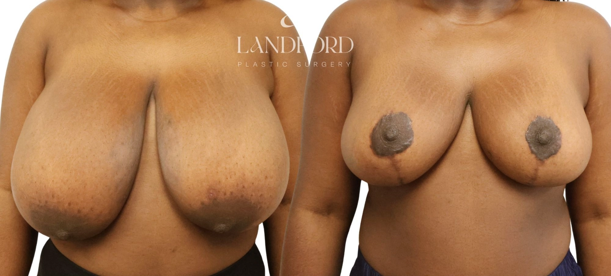 Breast Reduction