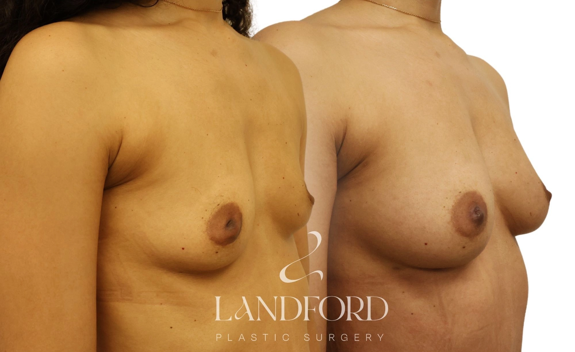 Breast Augmentation
