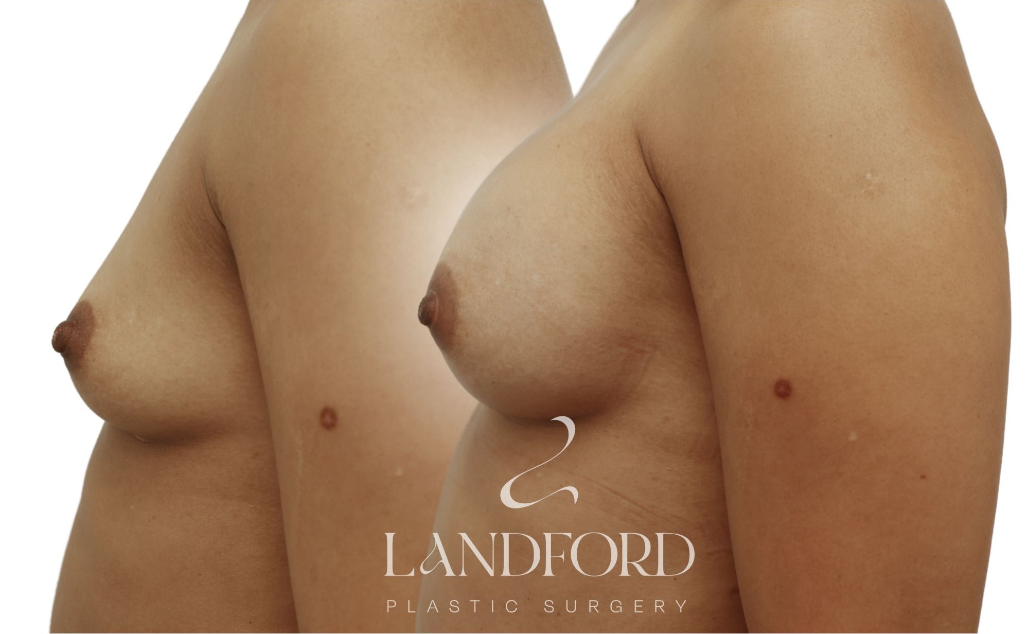 Breast Augmentation