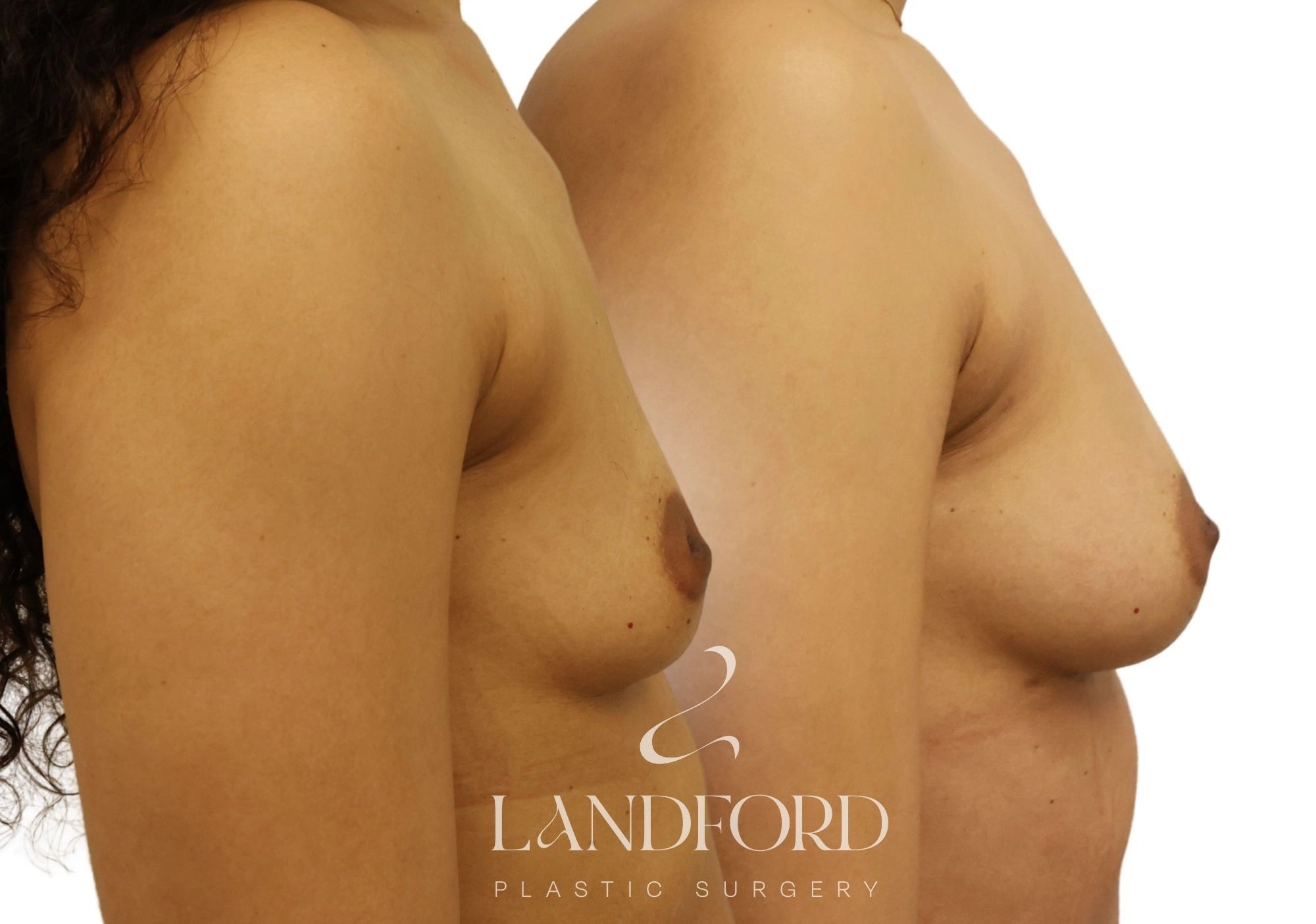 Breast Augmentation