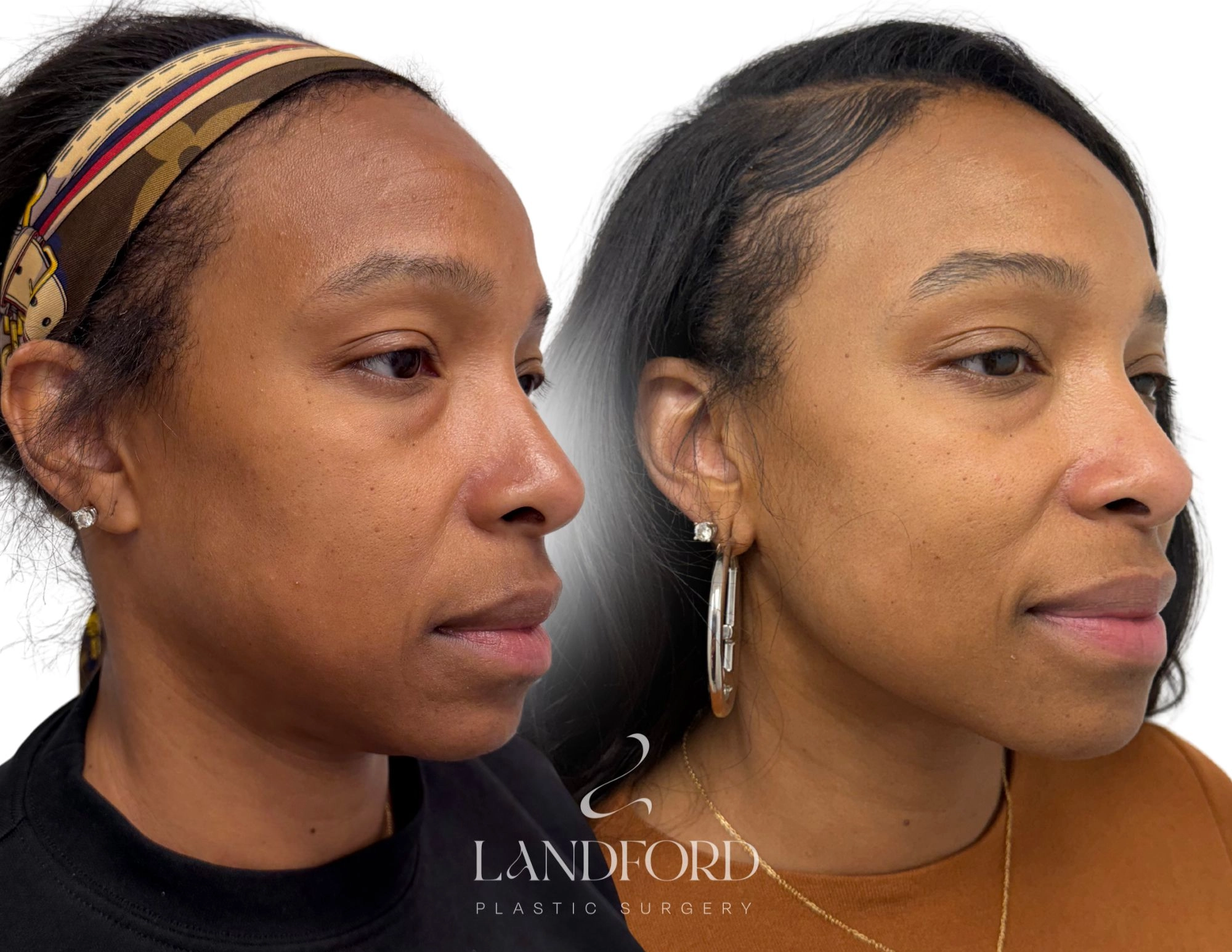 Neck & Chin Liposuction