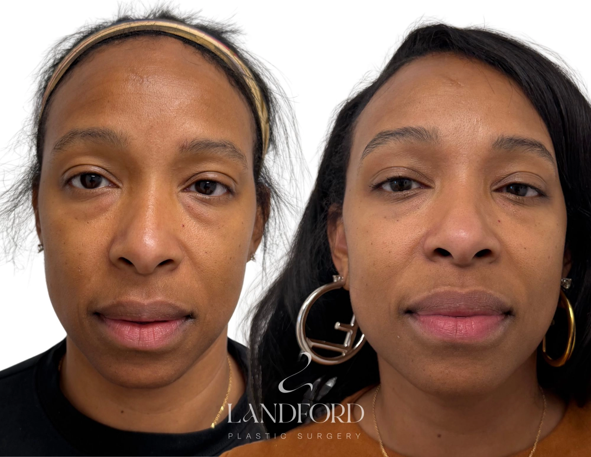 Neck & Chin Liposuction